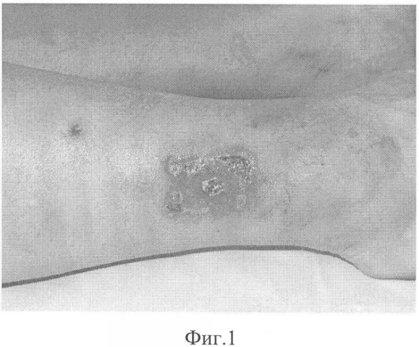 Способ лечения больных с недостаточностью клапанов перфорантных вен голени, осложненной трофическими язвами (патент 2328997)