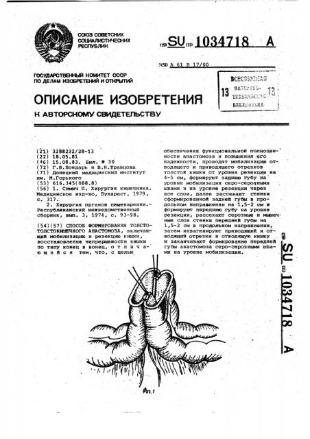 Способ формирования толсто-толстокишечного анастомоза (патент 1034718)