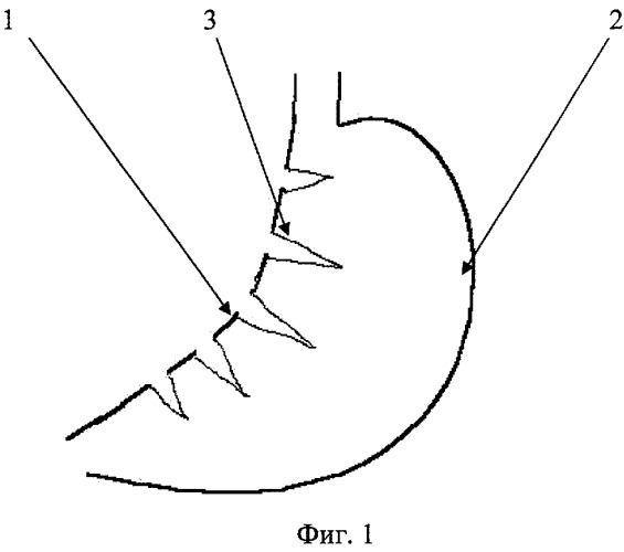 Способ создания желудочной трубки для пластического замещения пищевода (патент 2303429)