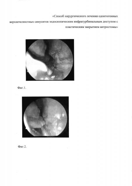 Способ хирургического лечения одонтогенных верхнечелюстных синуситов эндоскопическим инфратурбинальным доступом с пластическим закрытием антростомы (патент 2644697)