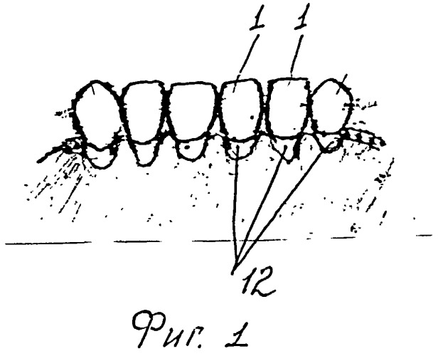 Способ вестибулопластики полости рта (патент 2531446)