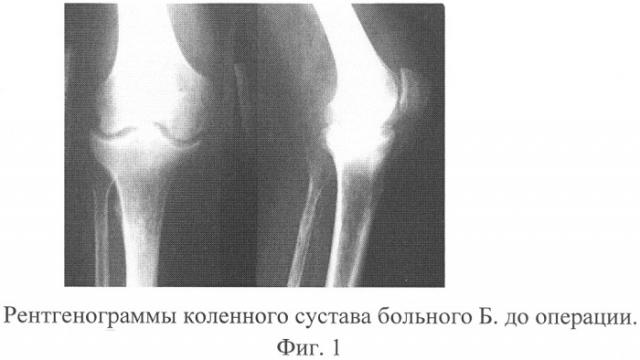 Способ лечения гнойного артрита, развившегося после тотального эндопротезирования коленного сустава (патент 2317022)
