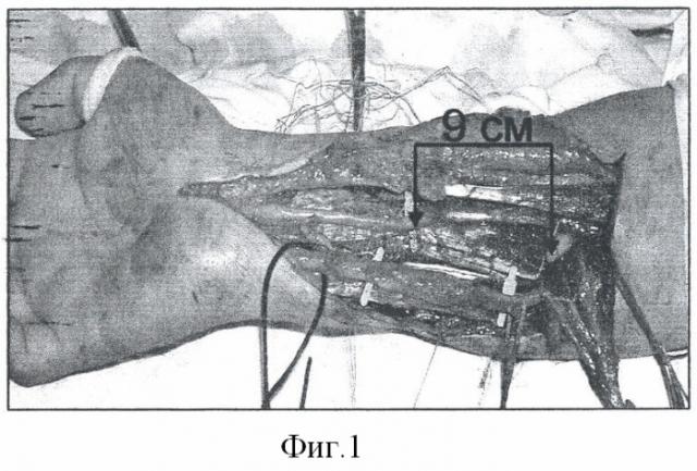 Способ хирургического лечения дефектов периферических нервов конечностей (патент 2356501)