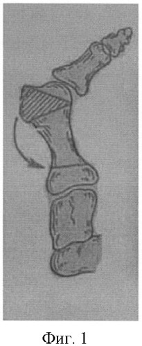 Способ оперативного лечения вальгусной деформации 1-го пальца стопы (патент 2393796)