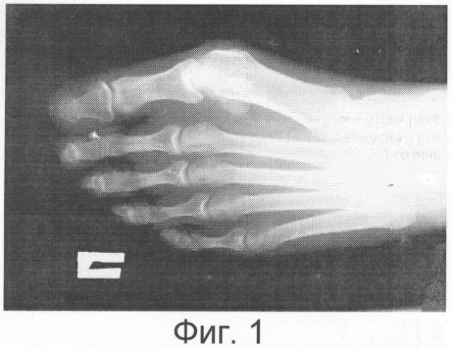 Способ хирургической реабилитации пациентов с вальгусным отклонением 1-го пальца стопы (патент 2310414)