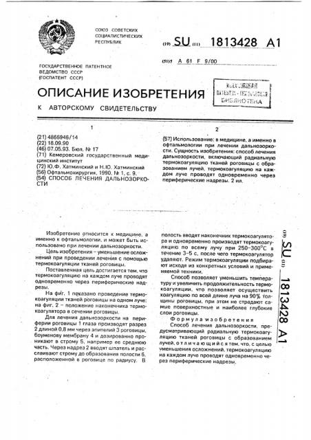 Способ лечения дальнозоркости (патент 1813428)