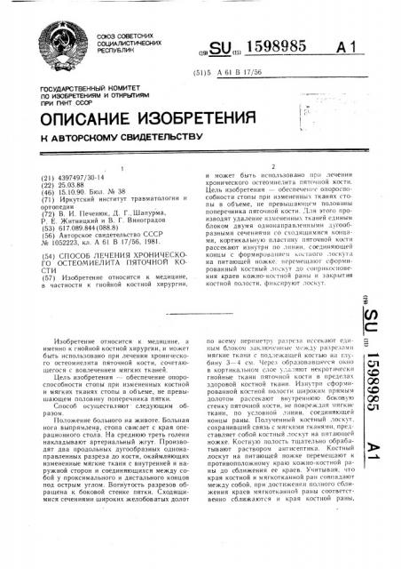 Способ лечения хронического остеомиелита пяточной кости (патент 1598985)