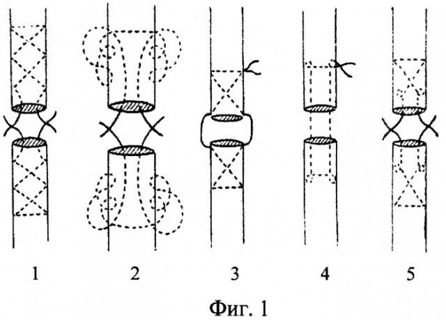 Способ пластики разорванных сухожилий (патент 2372862)