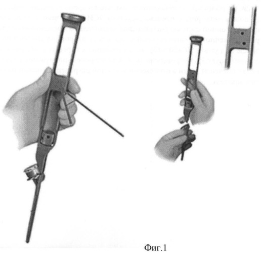 Способ интраоперационной навигации при эндопротезировании плечевого сустава однополюсным эндопротезом эси (патент 2467725)