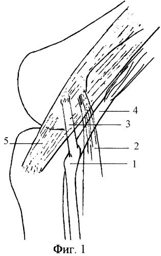 Способ лечения задне-наружной ротационной нестабильности коленного сустава (патент 2245683)