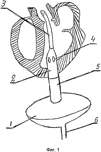 Искусственный желудочек сердца (варианты) (патент 2550047)