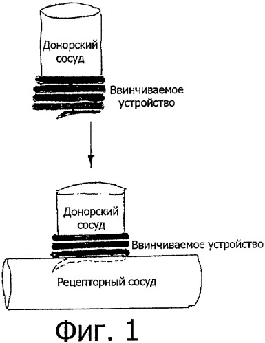 Ввинчиваемое устройство для анастомоза (патент 2329774)