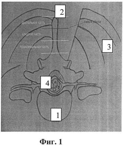 Способ реконструкции позвоночного канала при лечении стеноза пояснично-крестцового отдела позвоночника (патент 2531927)