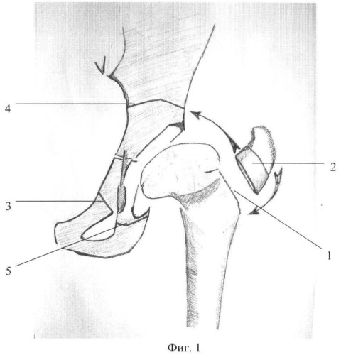Способ выполнения ротационной транспозиции вертлужной впадины (патент 2467717)
