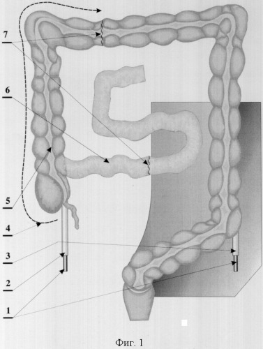 Способ илеоцекоцистопластики (патент 2323688)