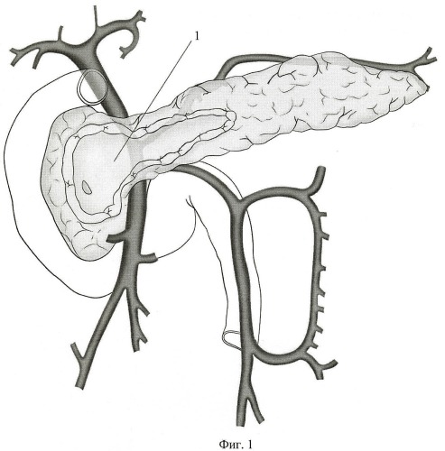 Способ хирургического лечения хронического панкреатита, осложненного тромбозом воротной вены (патент 2454957)