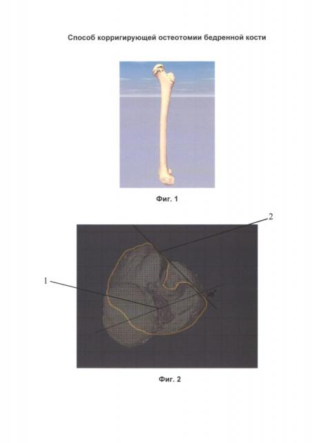 Способ корригирующей остеотомии бедренной кости (патент 2656018)