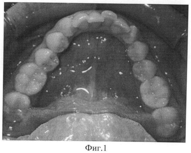 Способ ретенции результата ортодонтического лечения глубокого резцового перекрытия (патент 2495643)