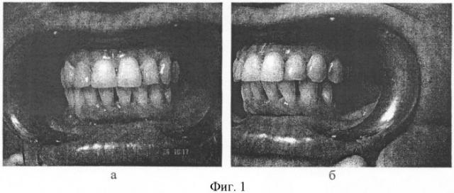 Способ оценки качества жизни у пациентов с дефектами зубных рядов (патент 2406440)