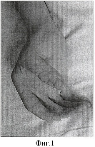 Способ устранения сгибательных контрактур и ульнарной девиации 2-5 пальцев кисти (патент 2411014)