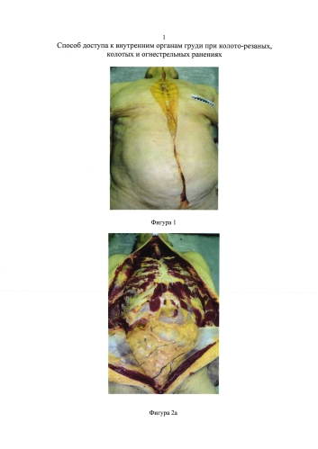Способ доступа к внутренним органам груди при колото-резаных, колотых и огнестрельных ранениях (патент 2579352)
