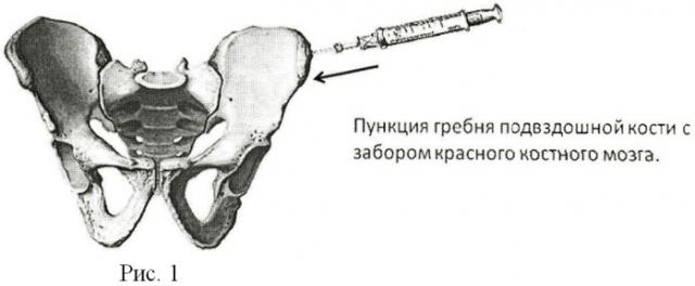 Способ ускорения регенерации костной ткани при проведении остеосинтеза (патент 2410050)