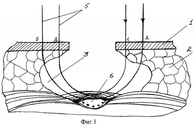 Способ оперативного лечения нагноившегося эпителиального копчикового хода у больных с высоким стоянием ягодиц и глубокой межъягодичной складкой (патент 2285467)