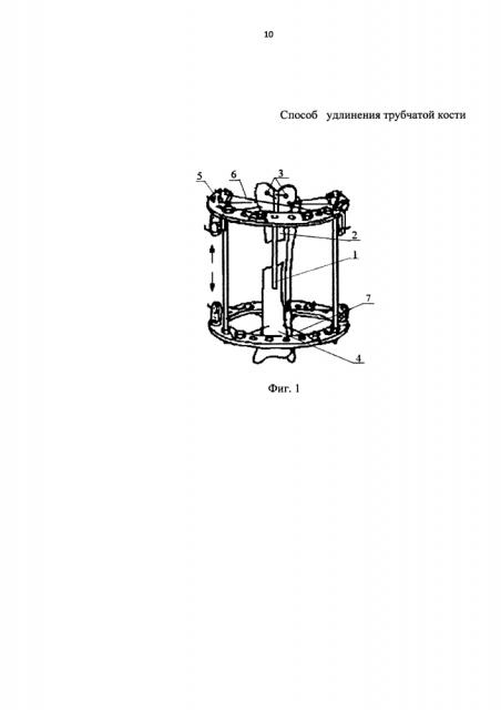 Способ удлинения трубчатой кости (патент 2613440)
