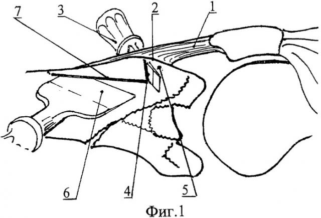 Способ остеотомии бугристости большеберцовой кости для доступа в коленный сустав (патент 2317033)