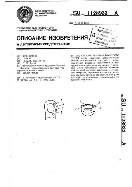 Способ лечения вросшего ногтя (патент 1128933)