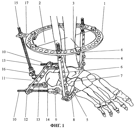 Способ лечения оскольчатых переломов пяточной кости (патент 2283628)