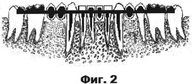 Интрадентальная шина из диоксида циркония (патент 2583146)