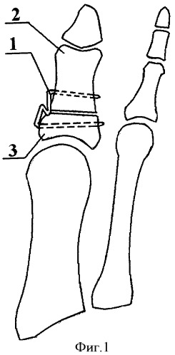 Способ оперативной коррекции вальгусной деформации первого пальца стопы (патент 2372043)