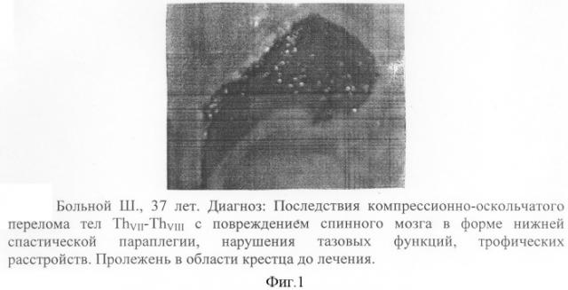 Способ лечения нейротрофических нарушений при последствиях травм спинного мозга (патент 2307679)