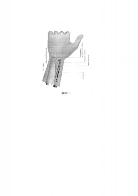 Способ хирургического доступа к дистальному отделу лучевой кости при переломах (патент 2625647)