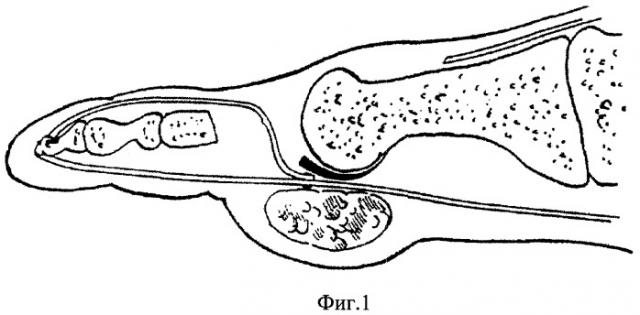Способ артропластики плюснефаланговых суставов (патент 2351292)