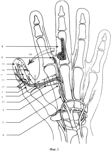 Способ восстановления утраченного первого пальца кисти (патент 2550935)
