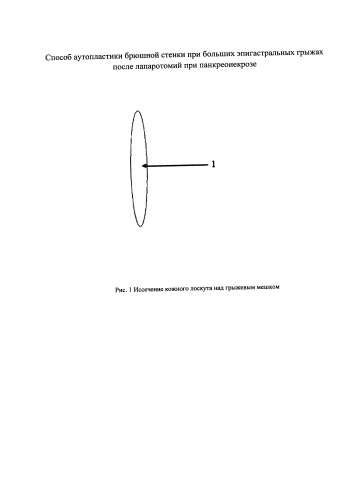 Способ аутопластики брюшной стенки при больших эпигастральных грыжах после лапаротомий при панкреонекрозе (патент 2587646)