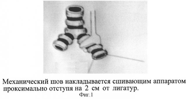Способ герметизации культи бронха (патент 2310397)