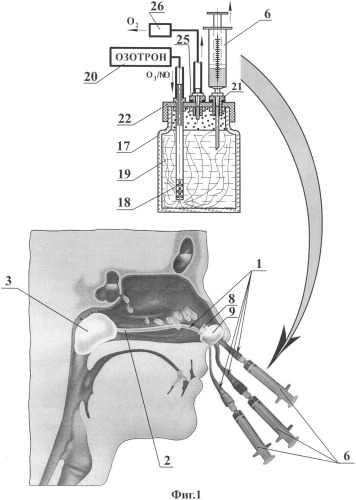 Устройство для озон/no-ультразвуковой терапии экссудативных синуситов (патент 2412683)