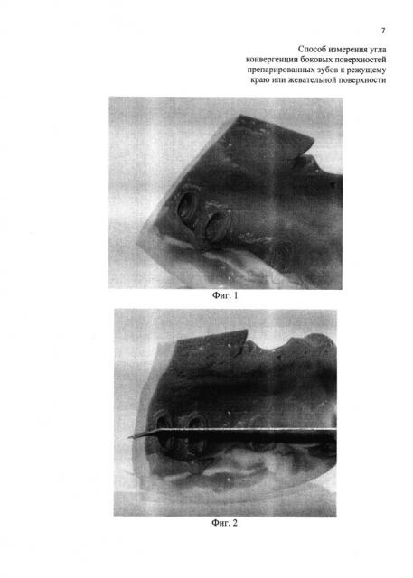 Способ измерения угла конвергенции боковых поверхностей препарированных зубов к режущему краю или жевательной поверхности (патент 2613433)