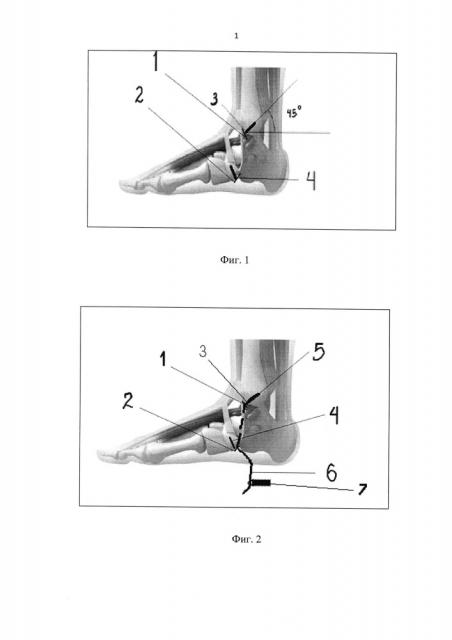 Способ лечения продольного плоскостопия (патент 2624371)