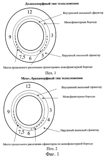 Способ хирургического лечения анальной трещины (патент 2293529)