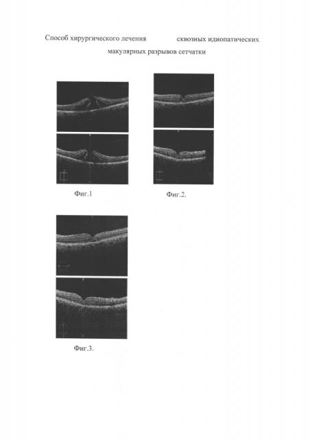 Способ хирургического лечения сквозных идиопатических макулярных разрывов сетчатки (патент 2652076)