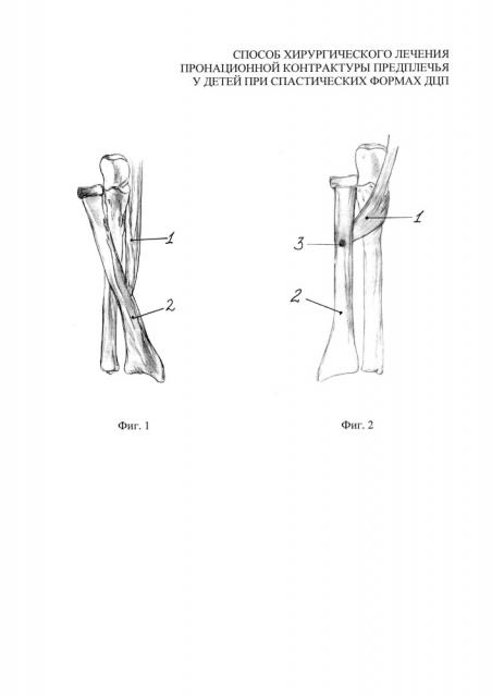 Способ хирургического лечения пронационной контрактуры предплечья у детей при спастических формах дцп (патент 2646574)