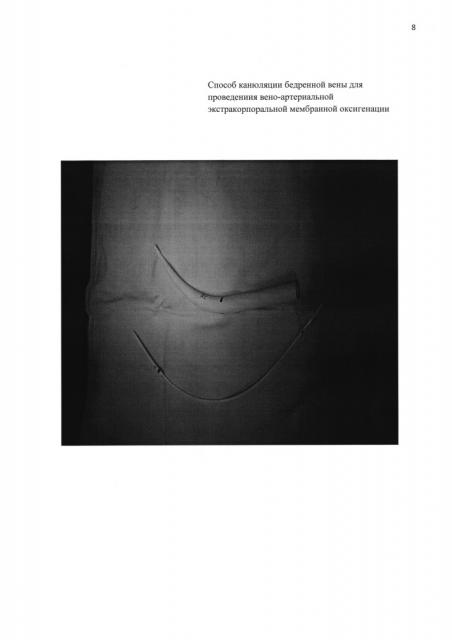 Способ канюляции бедренной вены для проведения вено-артериальной экстракорпоральной мембранной оксигенации (патент 2638287)
