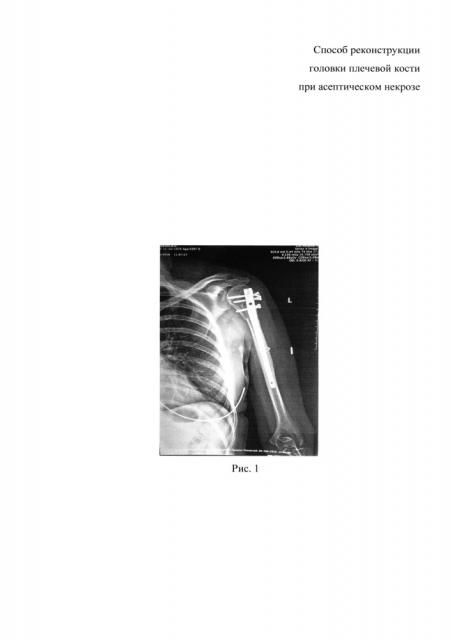 Способ реконструкции головки плечевой кости при асептическом некрозе (патент 2639400)