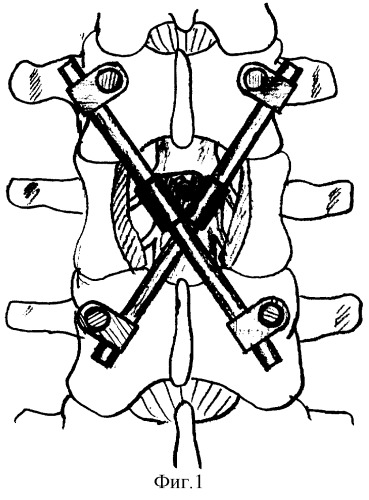 Способ транспедикулярной фиксации поврежденного позвоночного сегмента (патент 2271765)