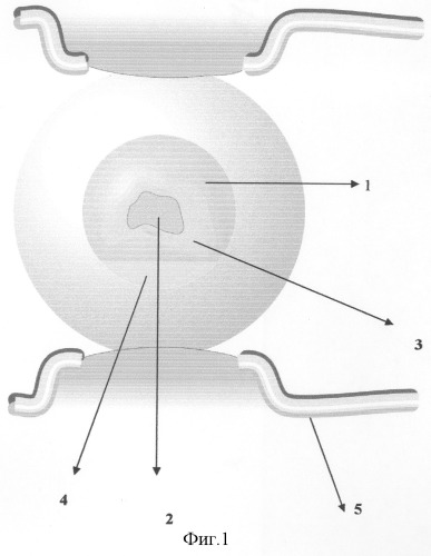 Способ лечения осложненной гнойной язвы роговицы (патент 2309710)