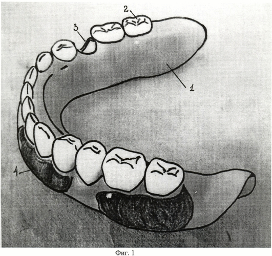 Частичный съемный протез на нижнюю челюсть (патент 2388429)